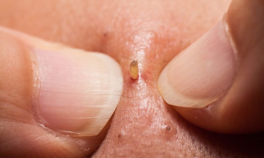 step by step guide to popping blackheads at home
